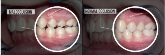 symptoms of an ill-fitting dental bridge