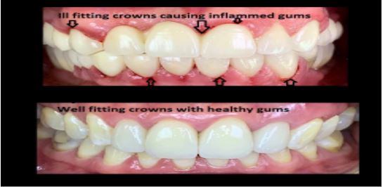 symptoms of an ill-fitting dental bridge