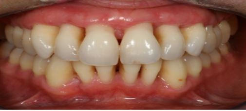 symptoms of an ill-fitting dental bridge