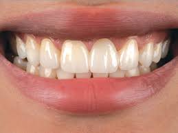 Replacing Front Teeth With A Bridge-Why, Pictures & Alternatives