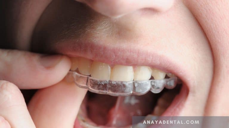 Can A Dental Bridge Be Removed And Recemented?