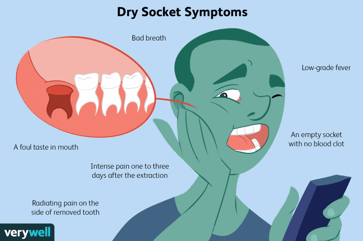 Dry Socket Causes, Symptoms, Diagnosis & Treatment