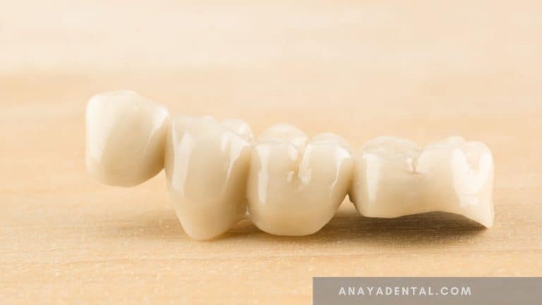 Temporary Dental Bridge- Why, Dental code, Benefits, Pictures & Material