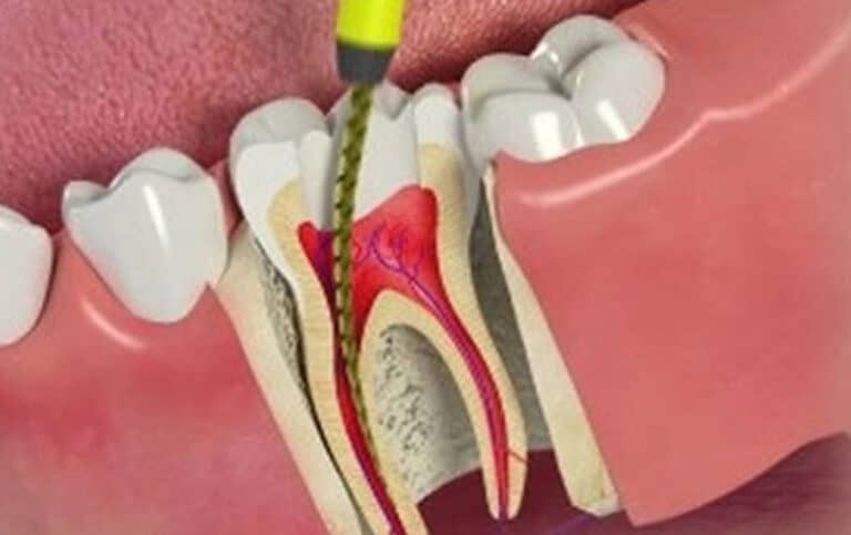 Root canal therapy- Everything you need to know