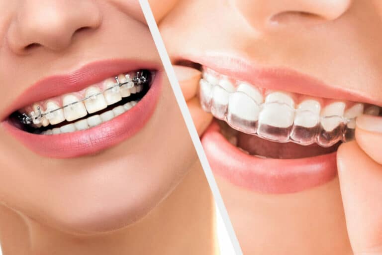 Braces vs invisalign: which is better?