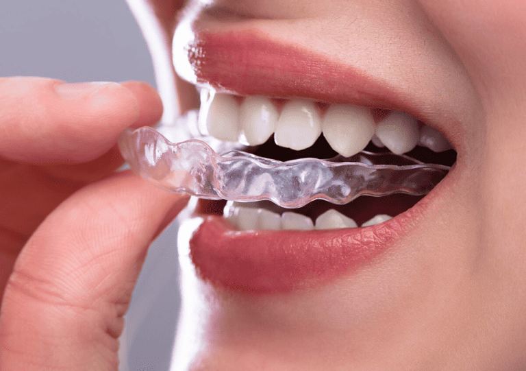 Side Effects of Invisalign