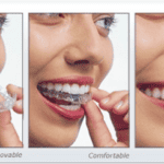 Invisalign with Periodontal/ gum Disease