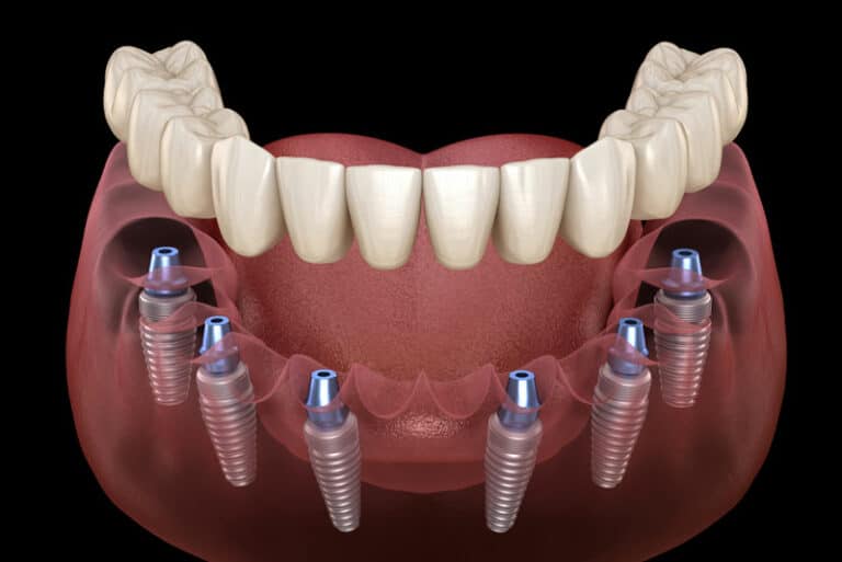 ALL ON 6 DENTAL IMPLANTS- PROCEDURE|ADVANTAGES|COST|AFTERCARE