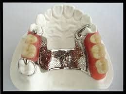 all you need to know about cast partial denture