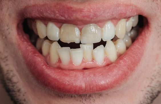 all you need to know about crooked teeth