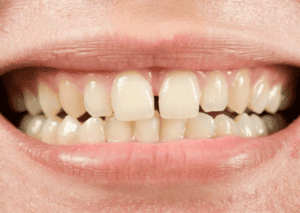 Gaps after braces: Why and What to do?