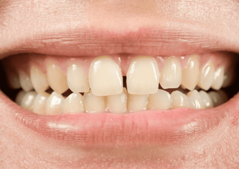 Gaps after braces: Why and What to do?