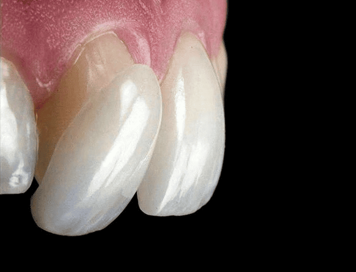 can veneers correct crooked teeth?