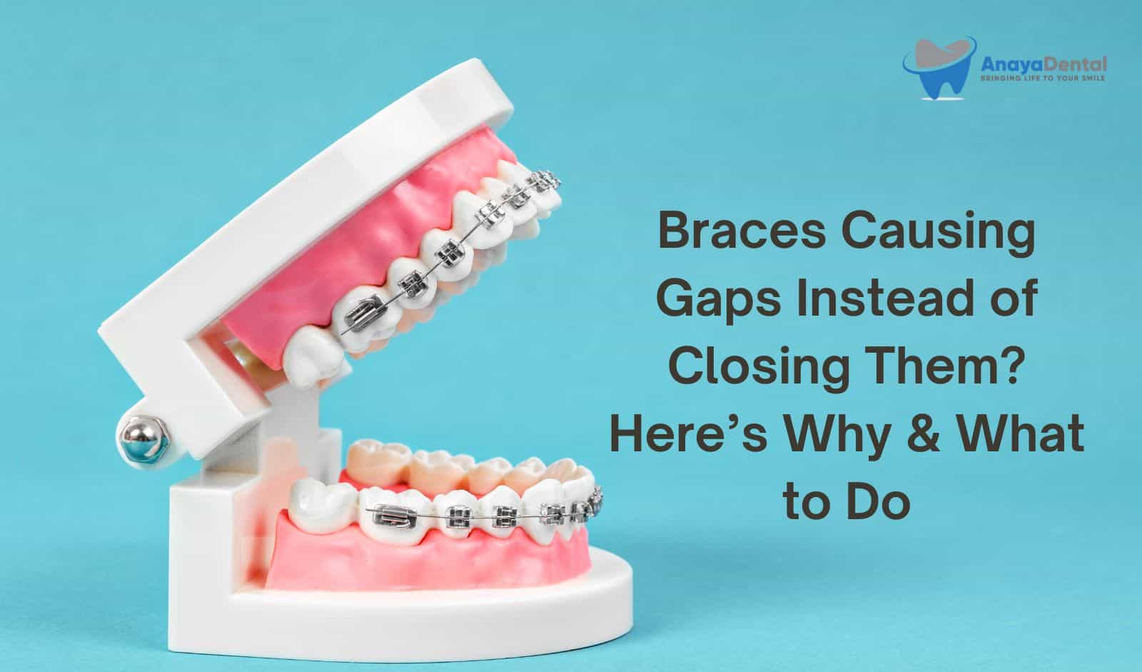 Braces Causing Gaps Instead of Closing Them? Here’s Why & What to Do