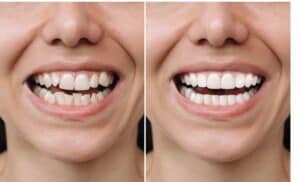 Can Veneers Correct Crooked Teeth