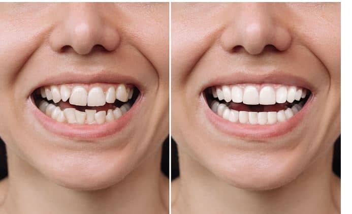 Veneers for Crooked Teeth: An Effective Solution?