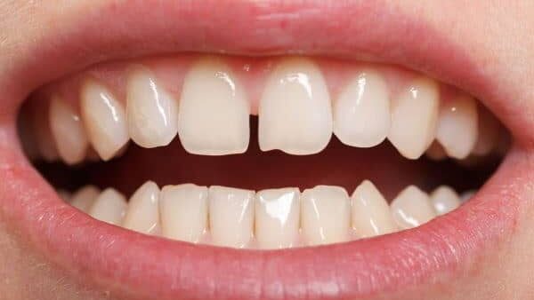 Gaps after braces