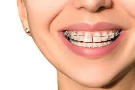 Braces Causing Gaps Instead of Closing Them? Here’s Why & What to Do