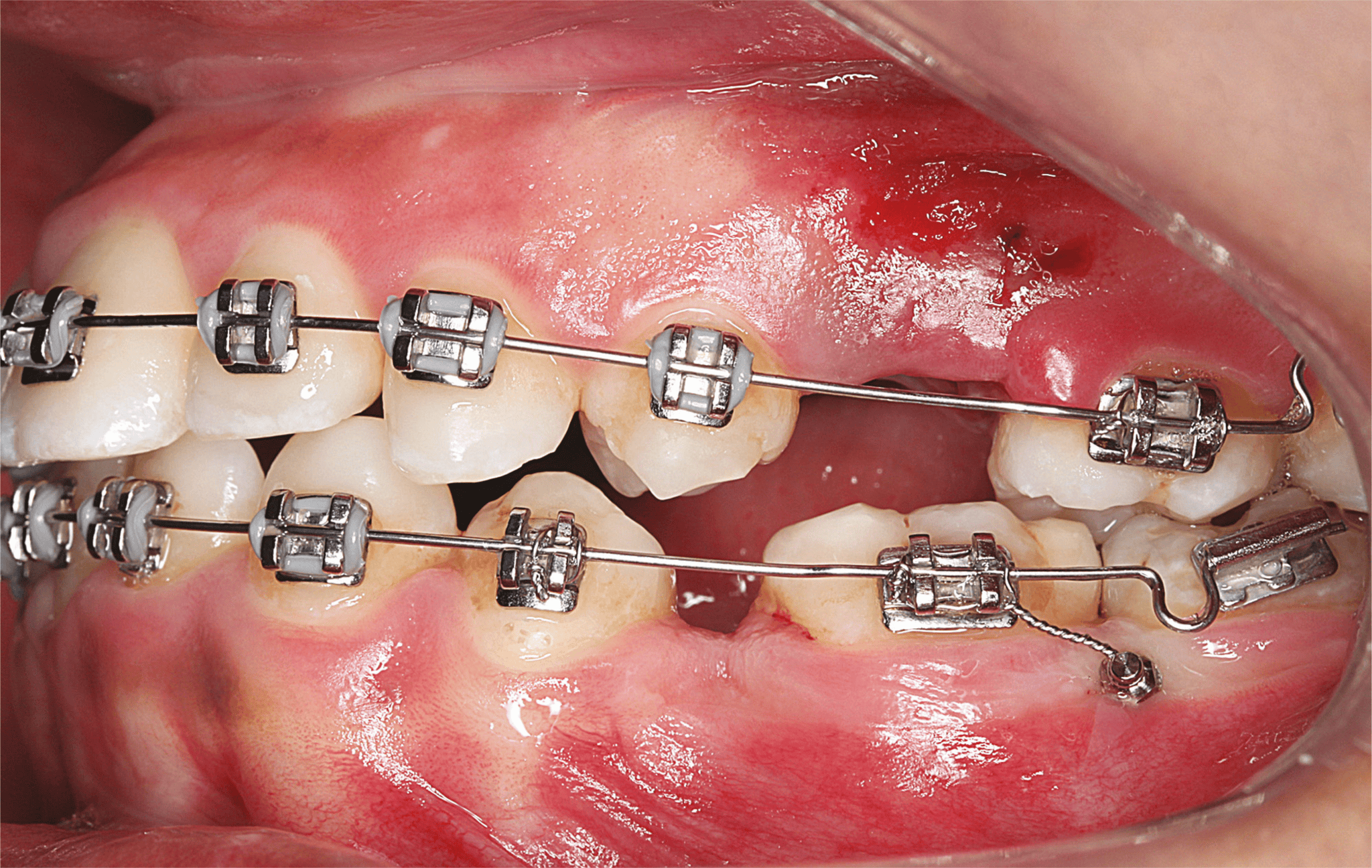 Orthodontic Mini Screw Implants: Your Guide to Selection and Use ...