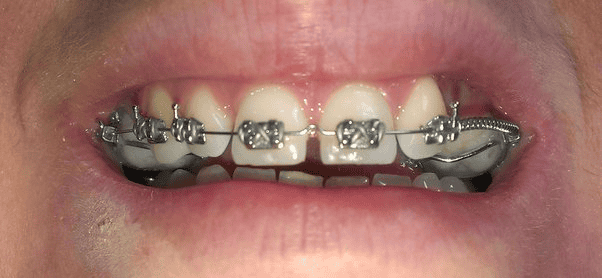 Gaps during orthodontic treatment