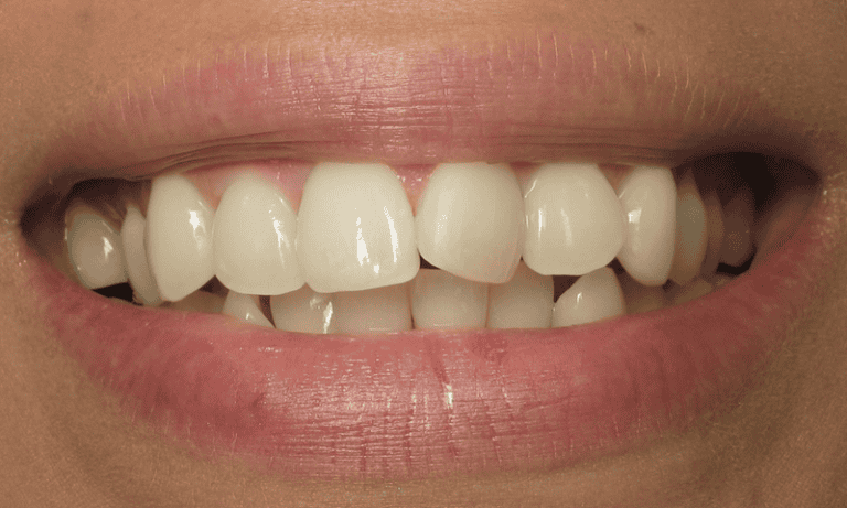 Best Treatment Plans for Rotated Teeth: From Braces to Veneers