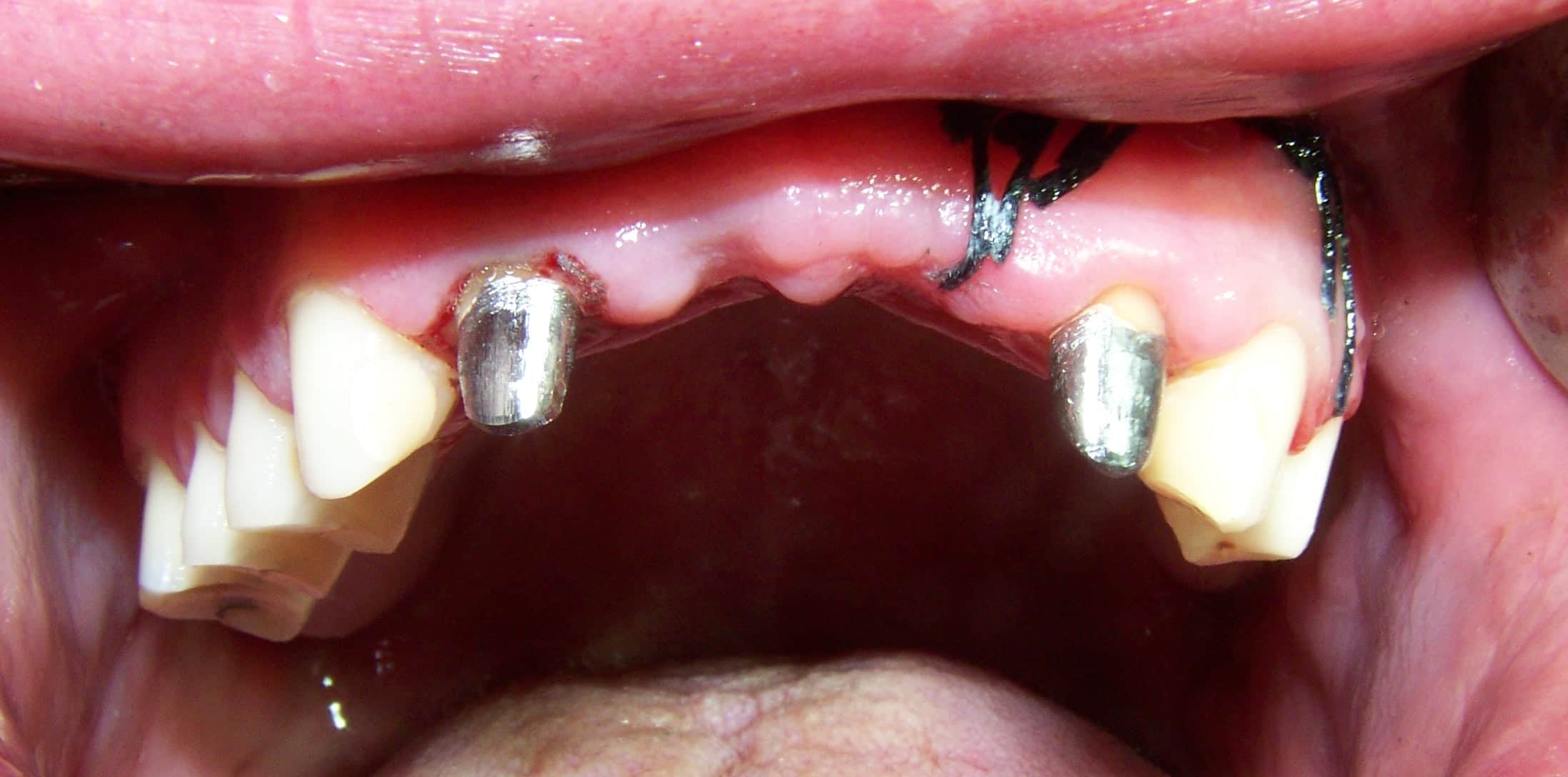 Replace Front Teeth with a Dental Bridge