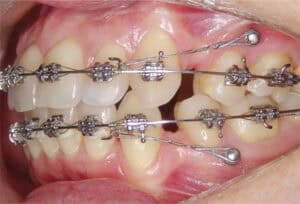 Orthodontic Mini Screw Implants