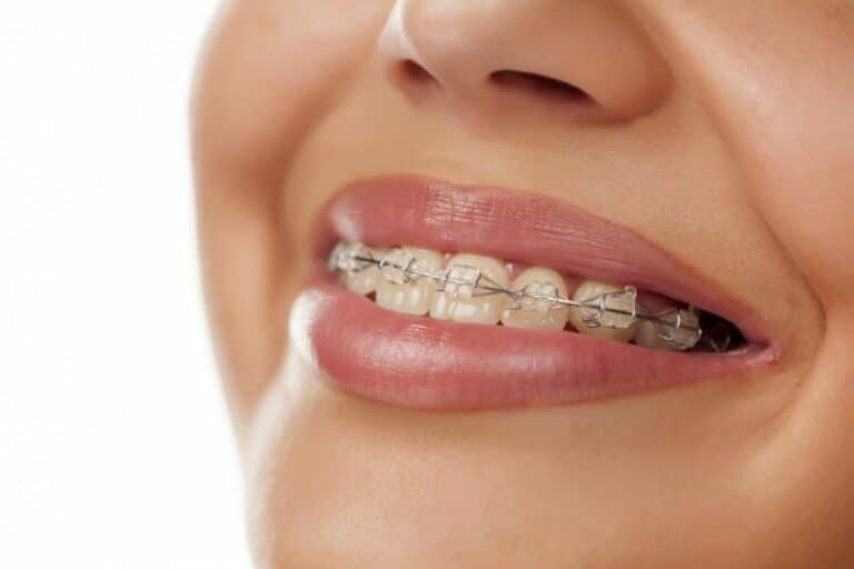 Best Treatment Plans for Rotated Teeth: From Braces to Veneers