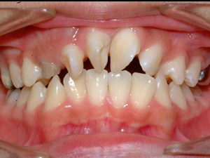 Rotated teeth: Treatment options and Cost guide