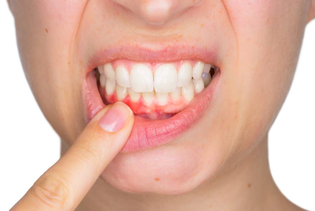 Increased sensitivity in surrounding teeth