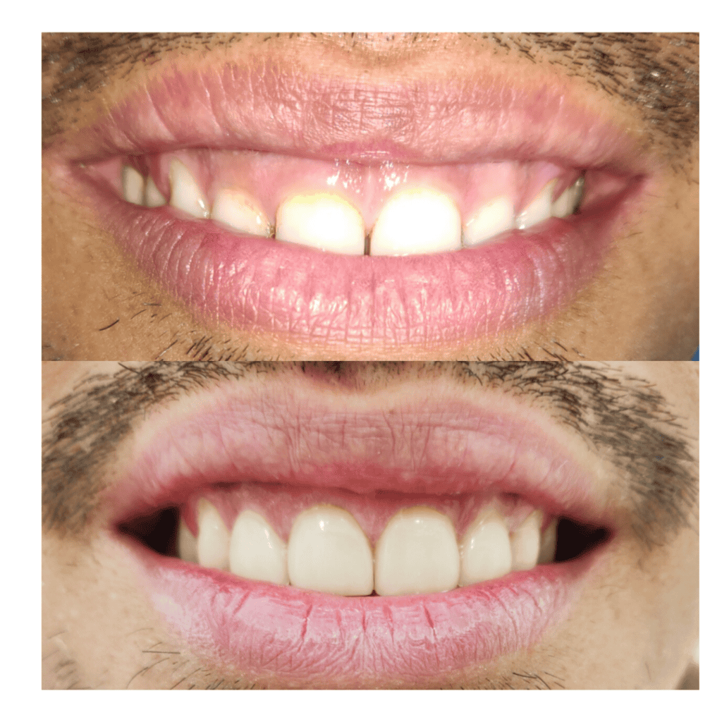 Before and after dental procedure picture