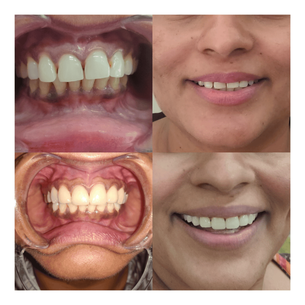 Before and after dental procedure picture