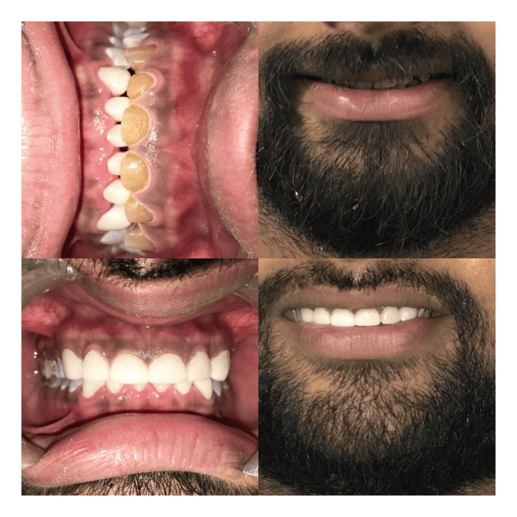 Before and after dental procedure picture