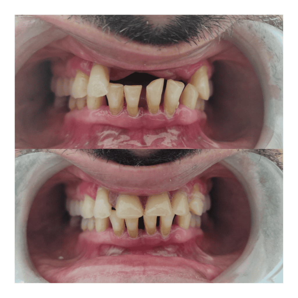 Before and after dental procedure picture