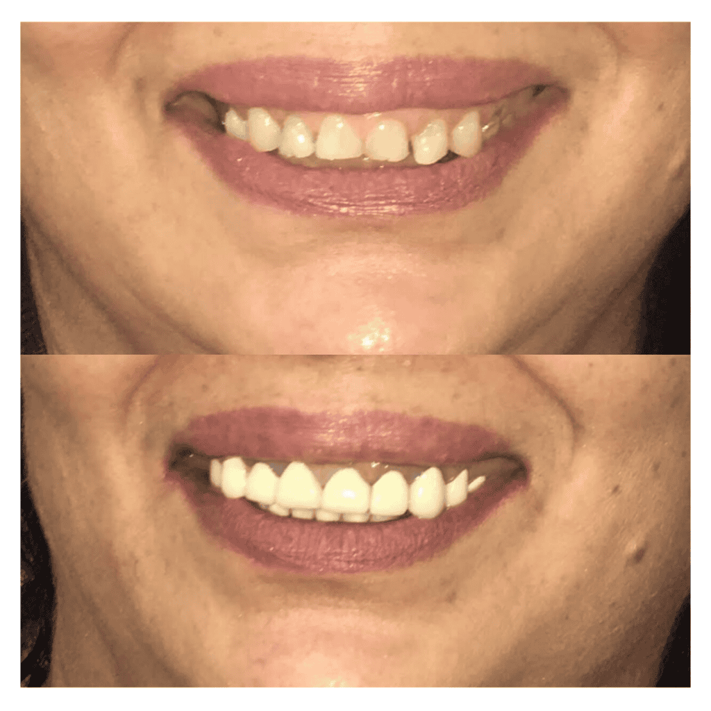 Before and after dental procedure picture