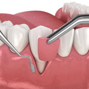 periodontic procedure