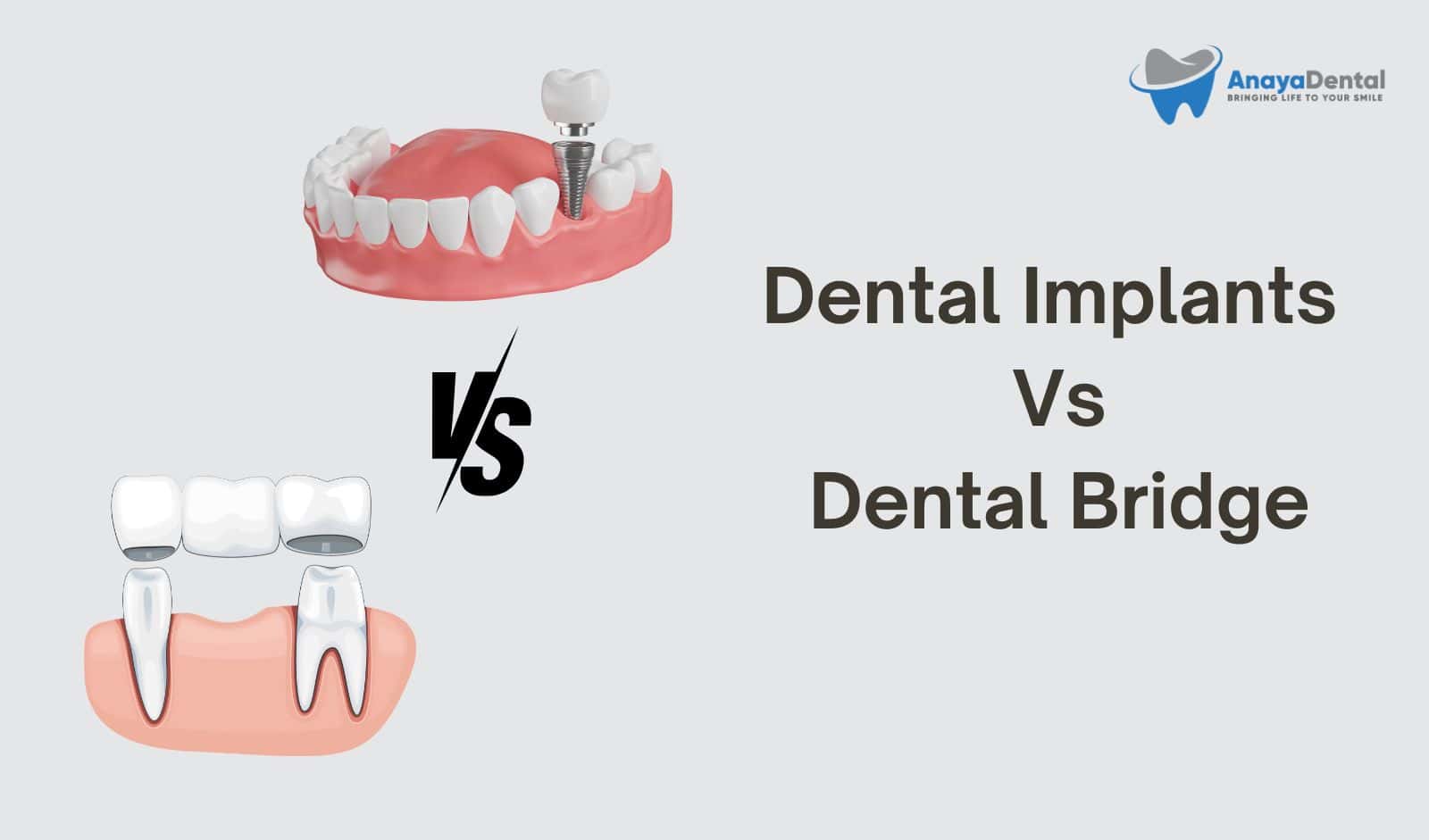 Dental implants vs Dental bridges