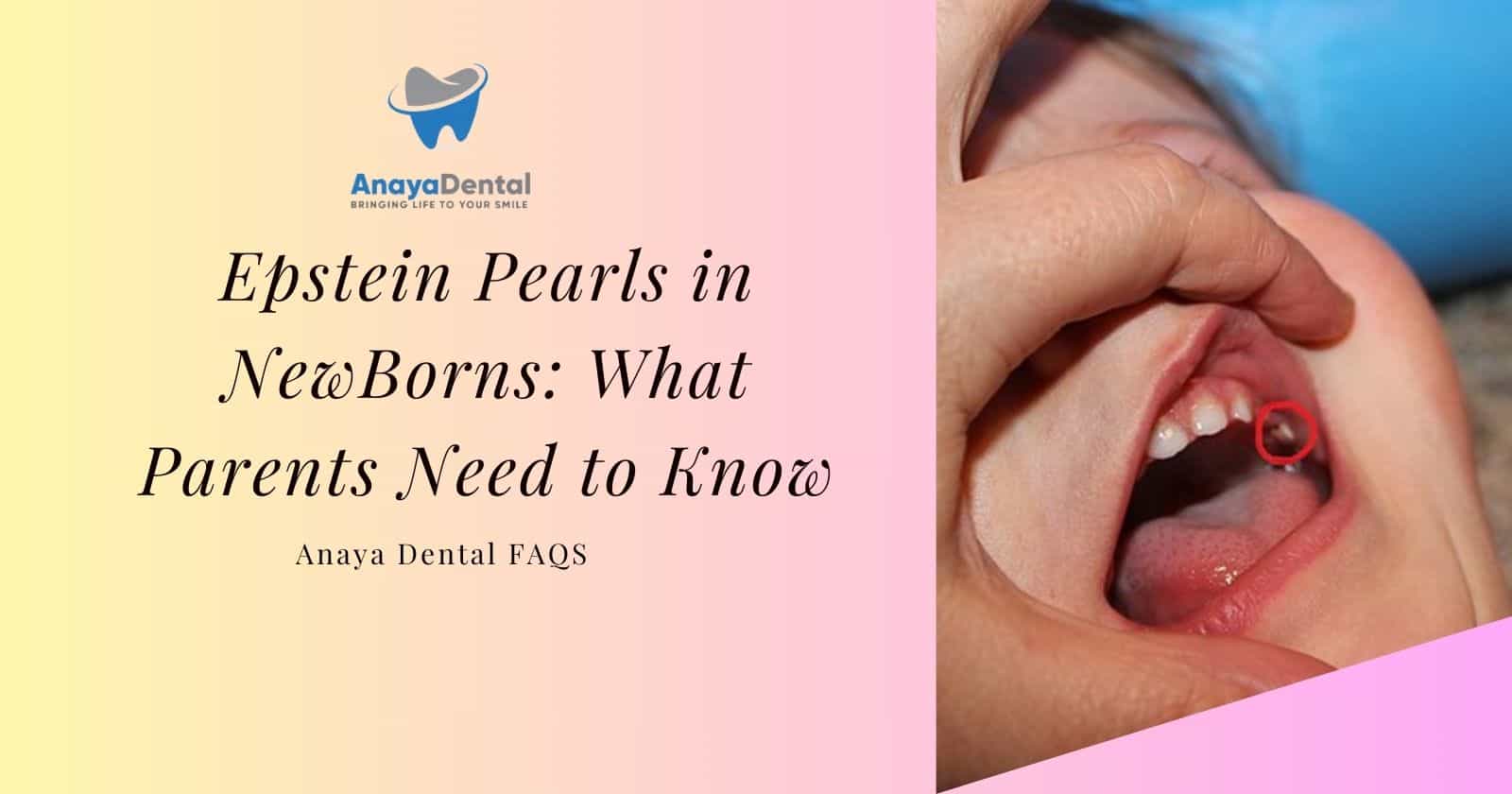 Epstein Pearls in NewBorns