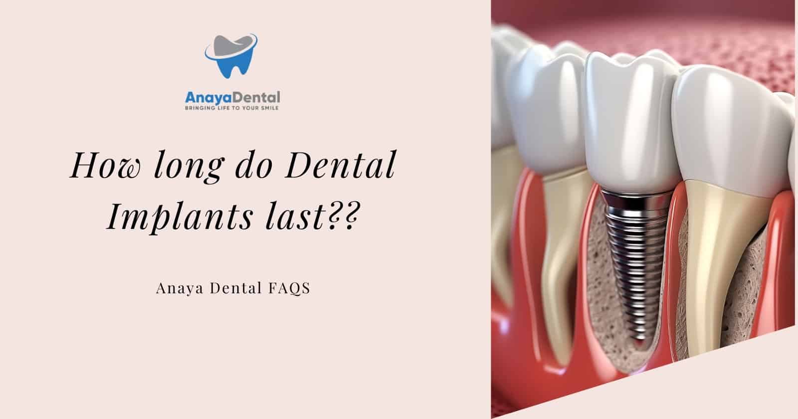 How long do Dental Implants last