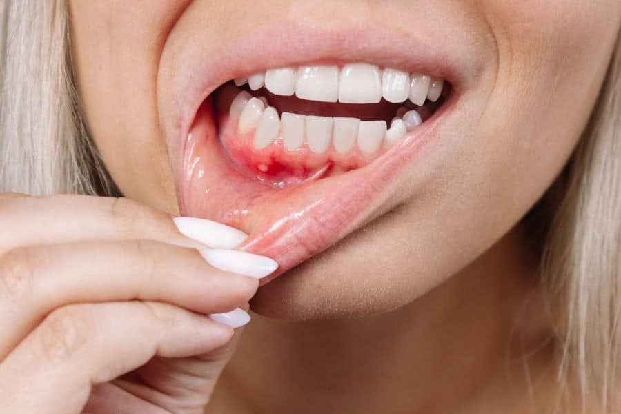 How to Cure Gum Disease Without a Dentist