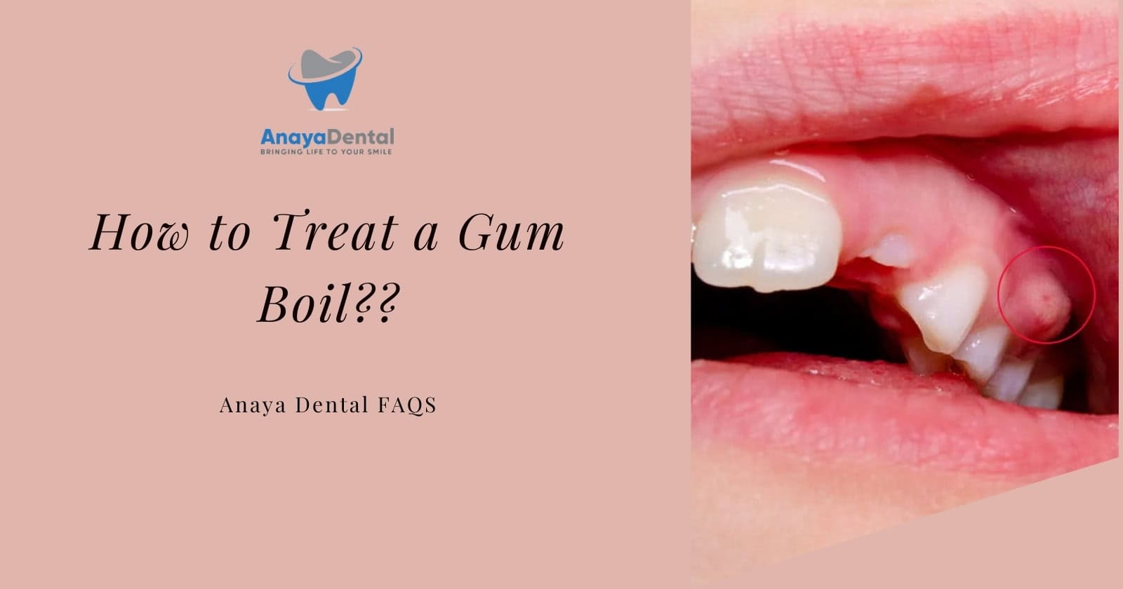 how to treat a gum boil