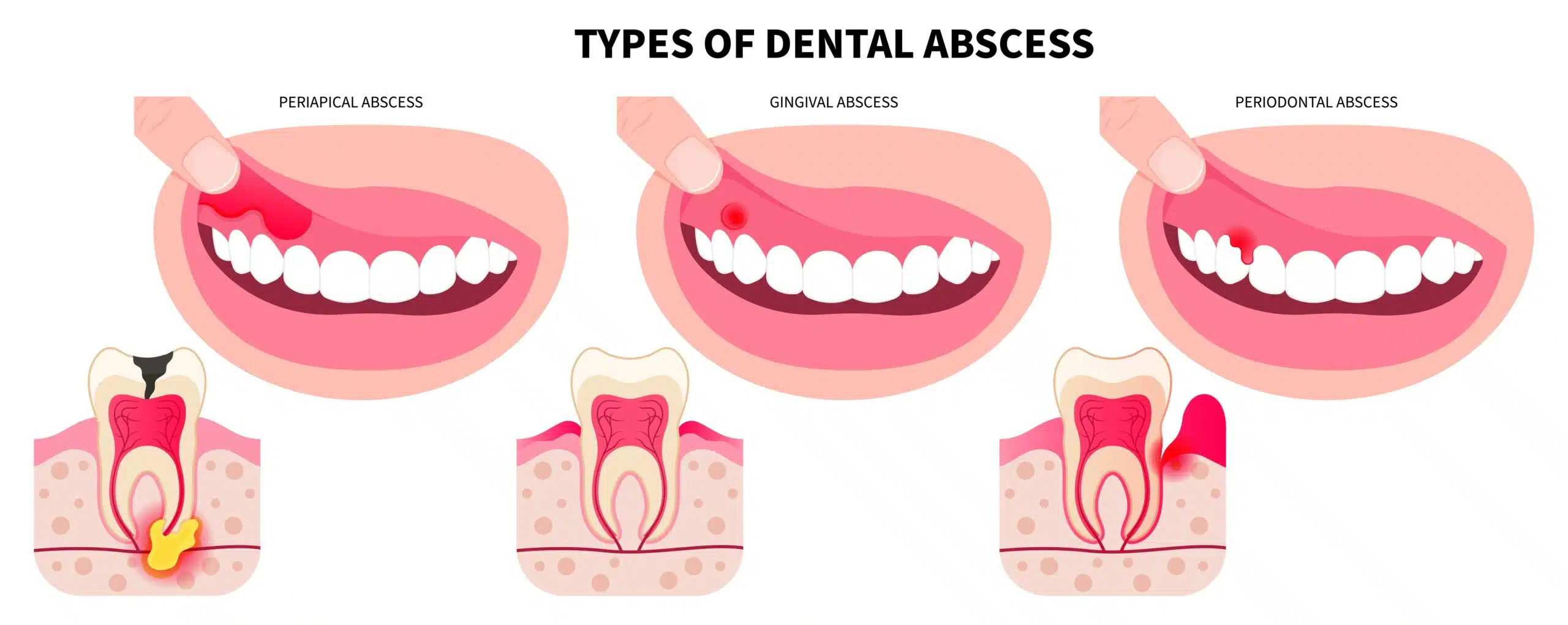 Types of Gum Boils