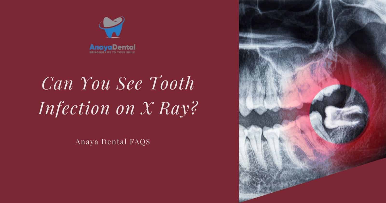 Can You See Tooth Infection on X Ray