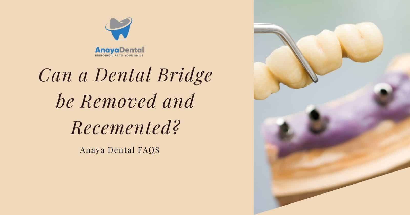 Can a Dental Bridge be Removed and Recemented