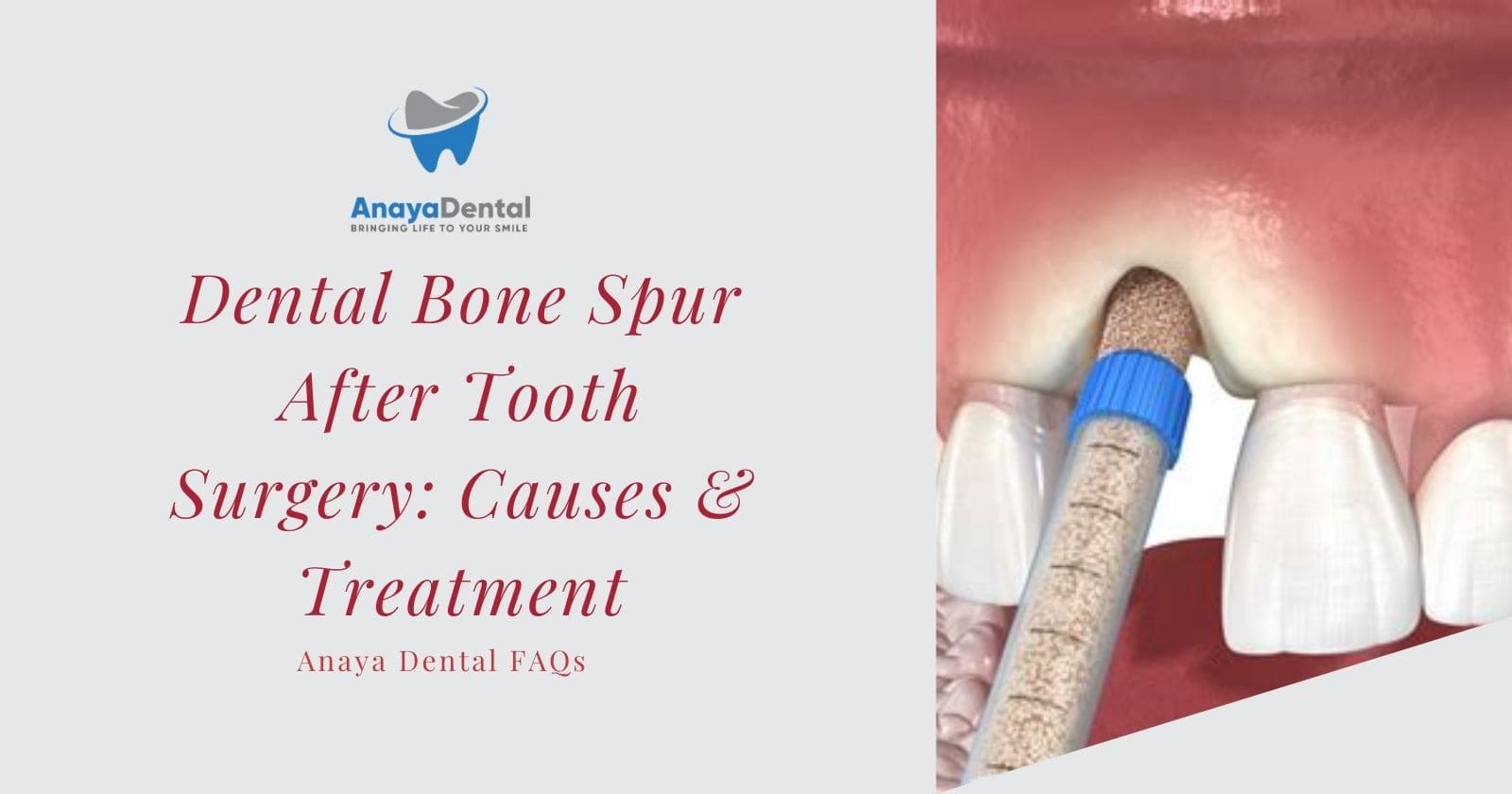 Dental bone spicule after Tooth Extraction