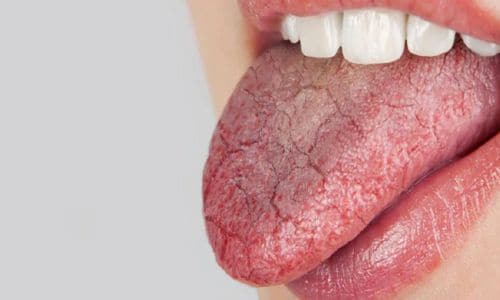 Dry Mouth (Xerostomia)