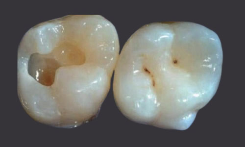 Tooth Dentin Pictures