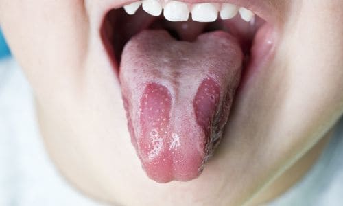 Geographic tongue