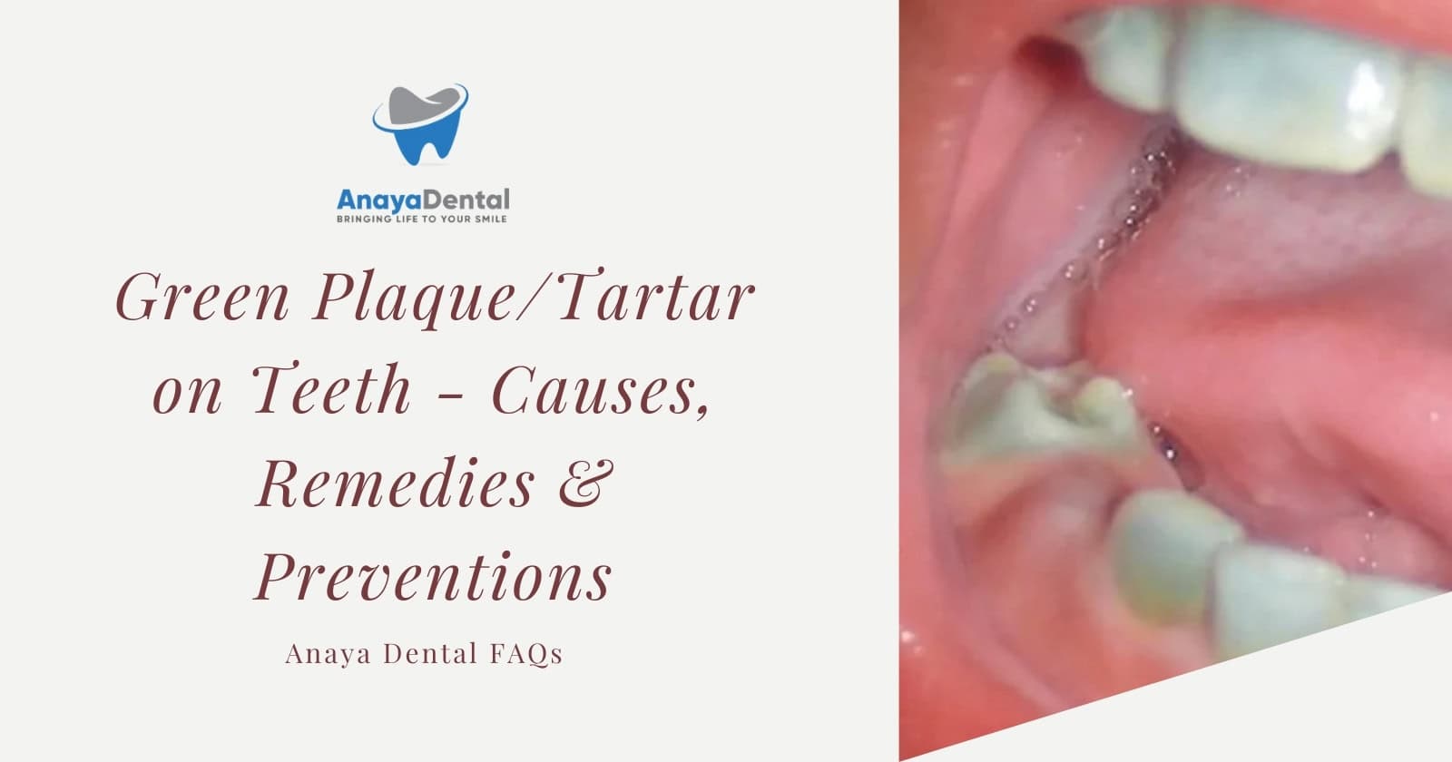 Green Plaque Tartar on Teeth