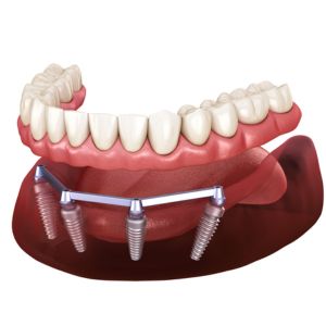 Hybrid Dentures